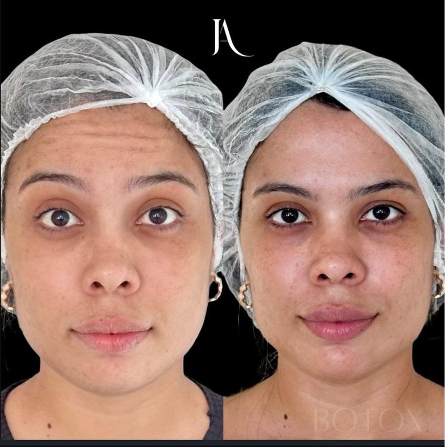 Harmonização Orofacial