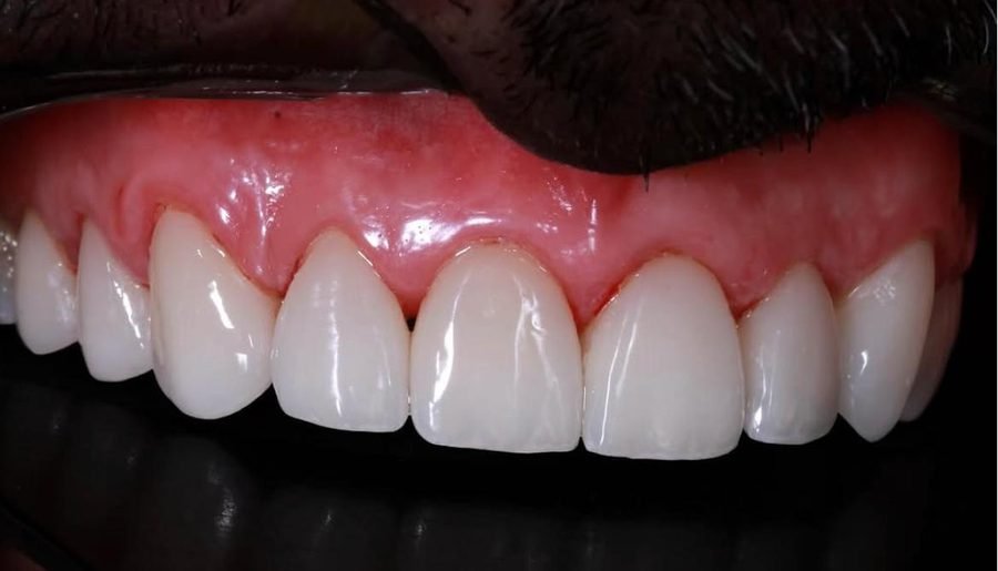 Lentes de Contato Dental